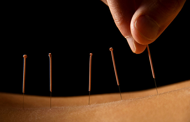 dry needling